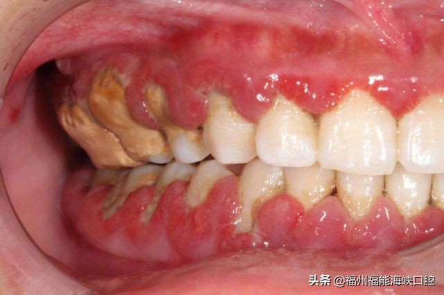 牙周炎的症状表现图片