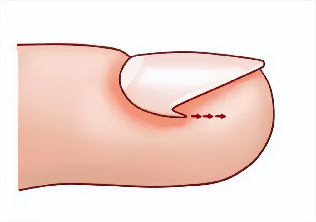 踢足球会引起甲沟炎吗(治甲沟炎，必须拔指甲？医生教你一招，在家就能缓解)