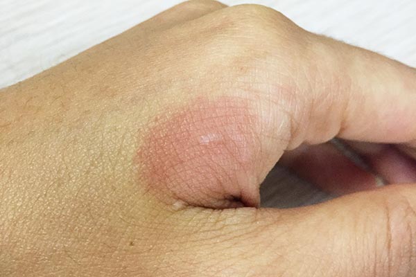 烫伤后该怎么做？偏方不能乱用，正确处理是关键，正确方法要收下