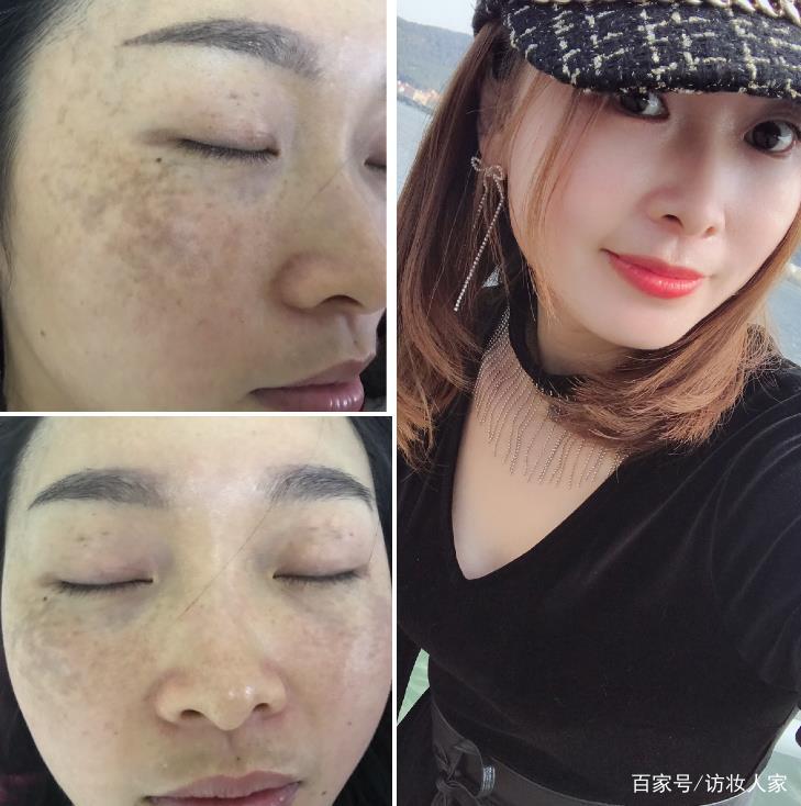 苗蓮花祛斑是真的嗎?如何判斷這個品牌靠不靠譜