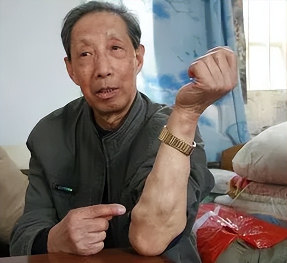 脂肪瘤对人体有多大危害?会不会癌变?医生告诉您