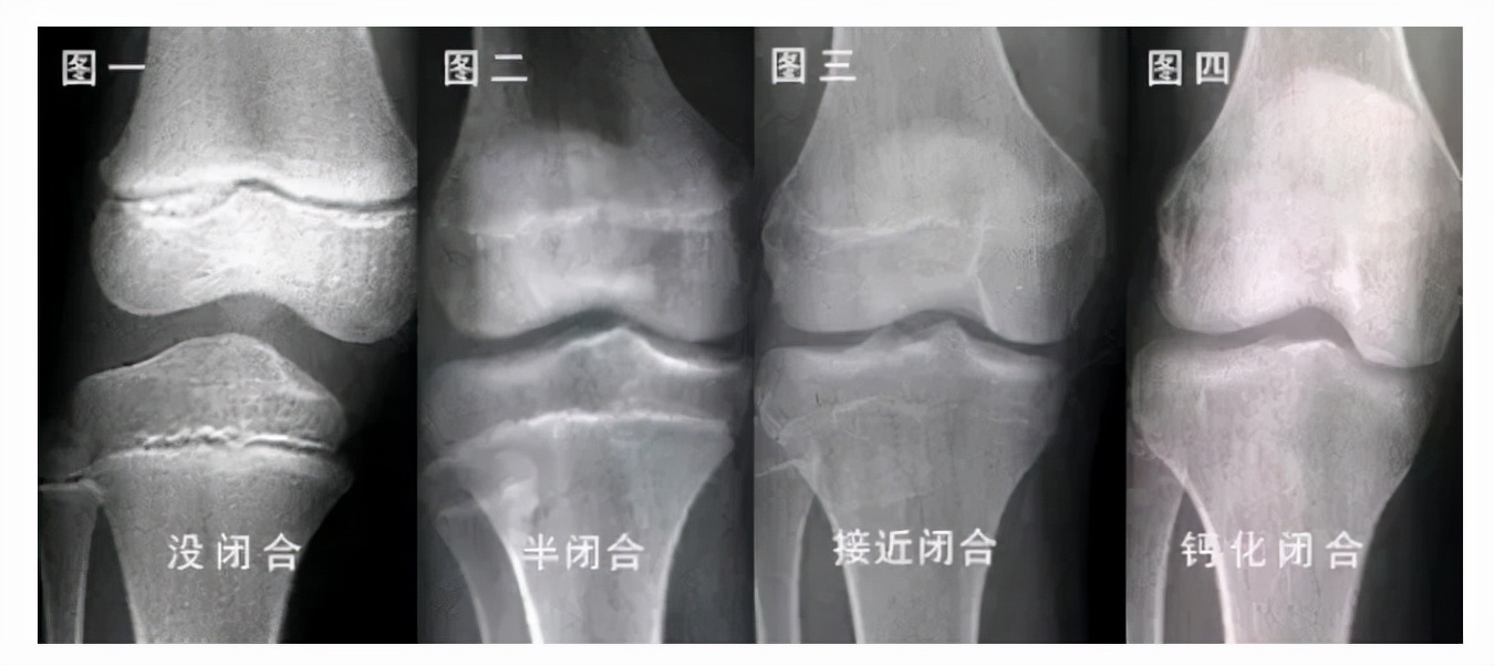 花了家里16万切断双腿骨头，只为增高7cm的男生，如今成功了吗？