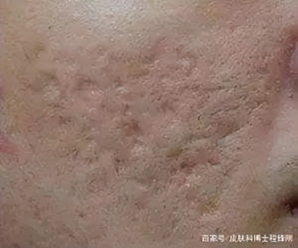 如何去痘疤(长痘痘后留下的疤痕怎么办?)