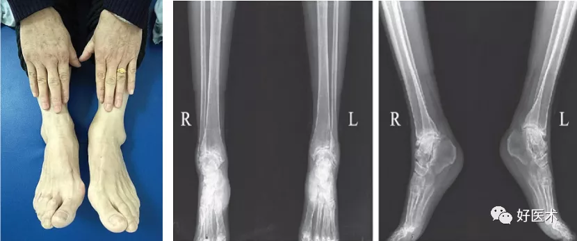 这种骨关节病“不普通”，提早诊疗是关键