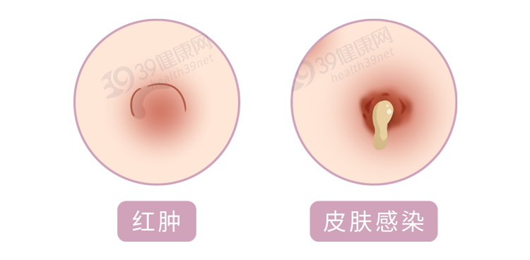 整容大概要多少钱(“16岁开始整容，花了400万”：不要命的美，害了多少年轻女孩)