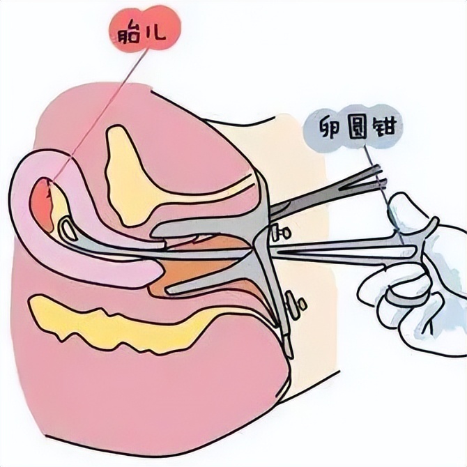 图|人工流产负压吸引术钳刮术:用卵圆钳将子宫内大块的胚胎组织夹出后