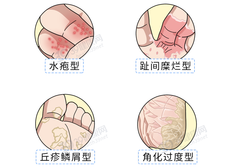 怎么样治疗灰指甲(得了灰指甲，反复发作很难受？一次性介绍3种药，总有一款能起效)