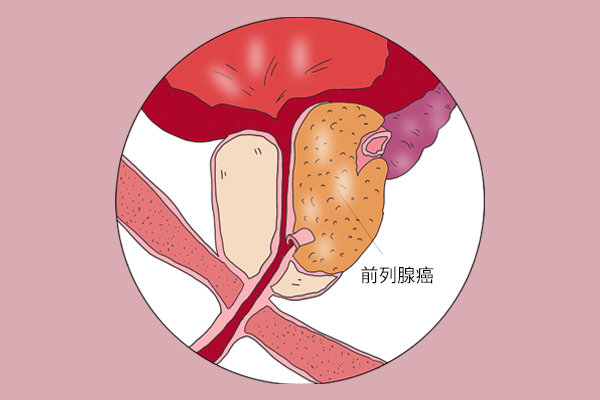 男性经常染发患前列腺癌风险增加77%，是真的吗？还能染发吗？