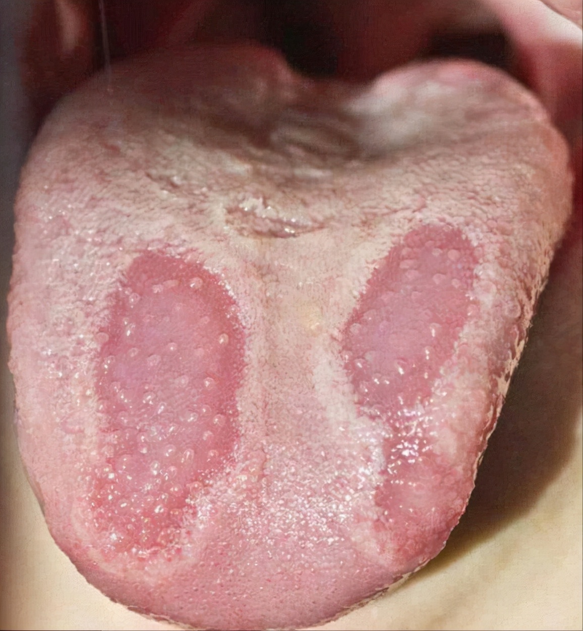 正常舌头图片(舌苔你会看吗) - 赤虎壹号