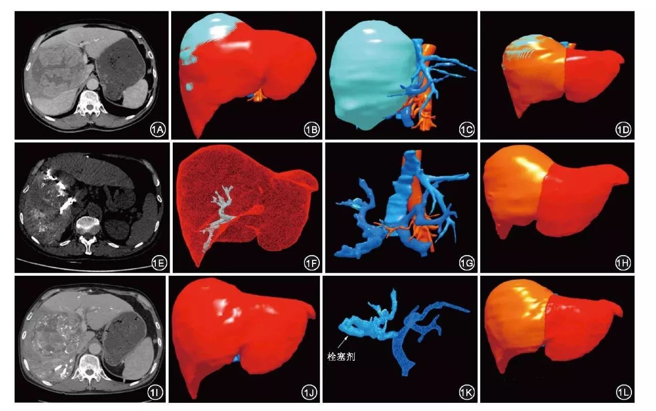肝病患者为什么会出现腹水？有三个因素，中西医治疗有哪些不同？