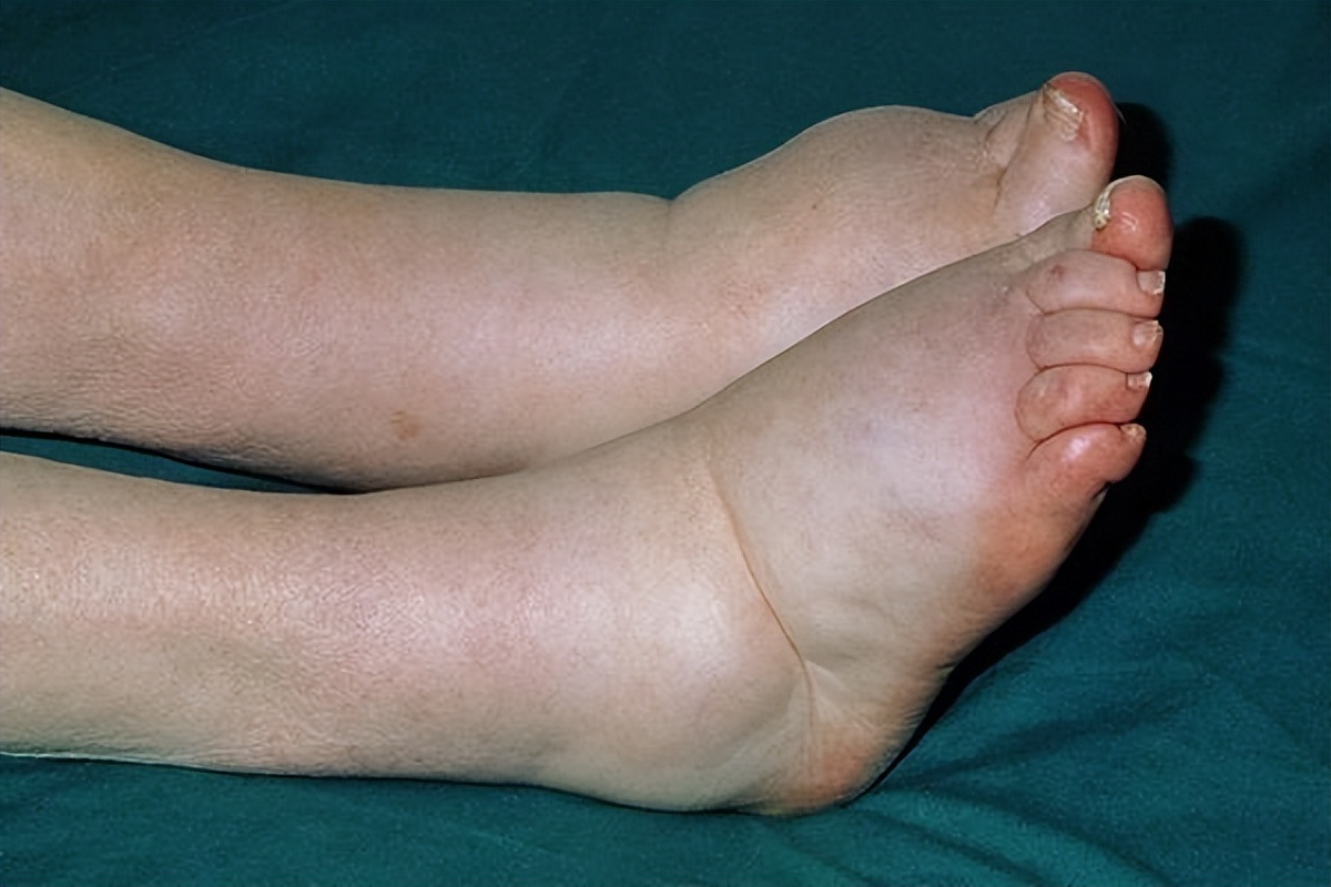 肝脏疾病早期会诱发哪些不良症状?你知道吗?