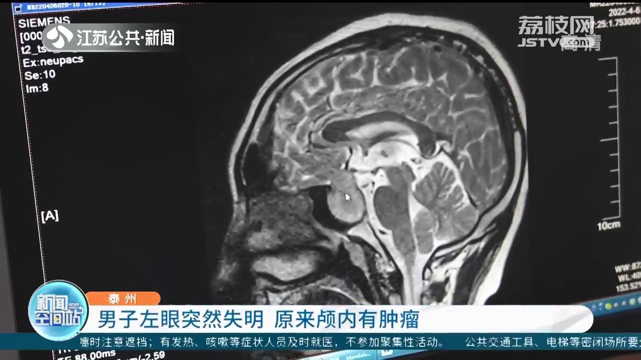 泰州一男子左眼突然失明 原来颅内有肿瘤