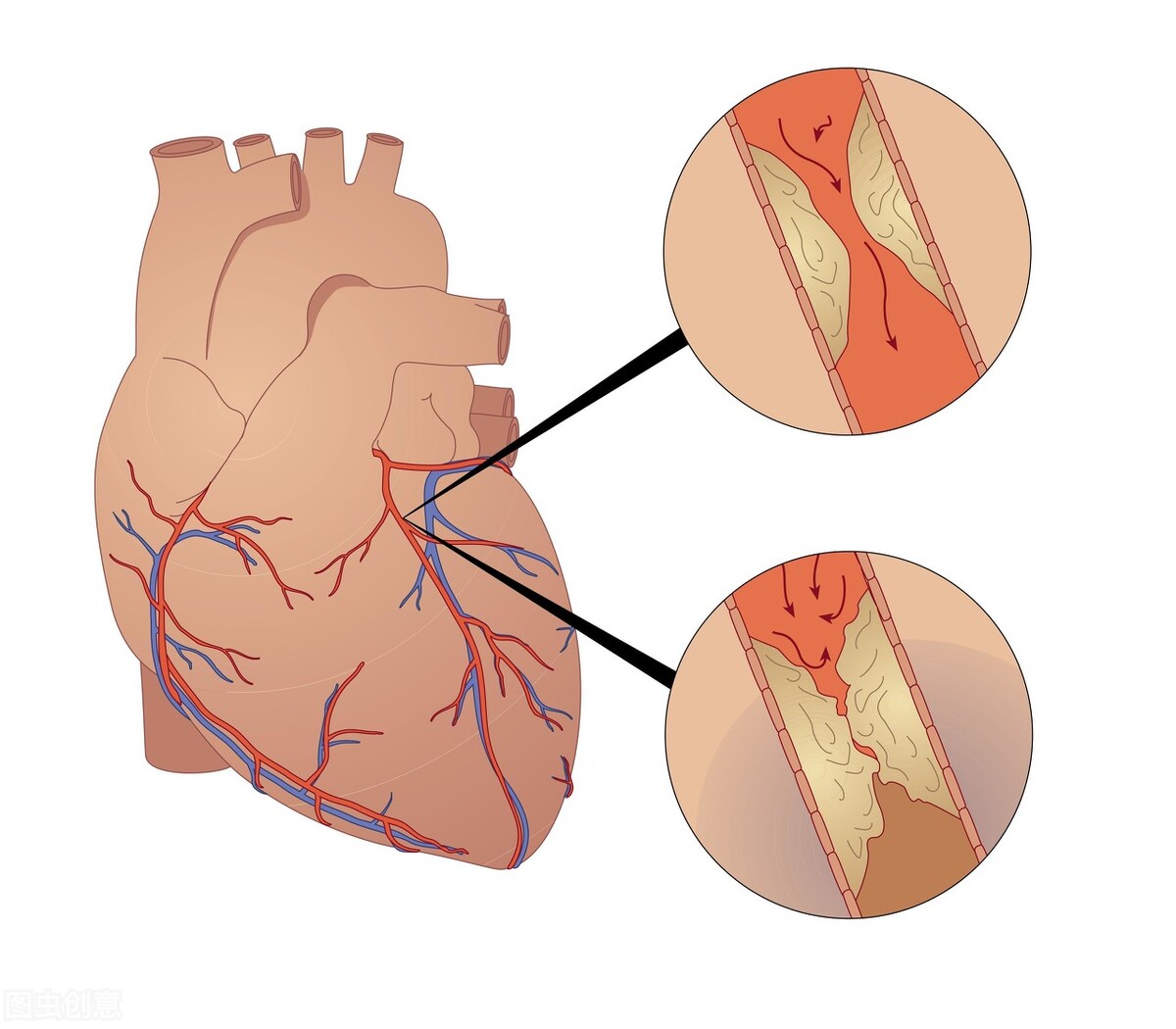 提醒:血栓不只出现在心脏,不同部位发生栓塞,症状各有不同