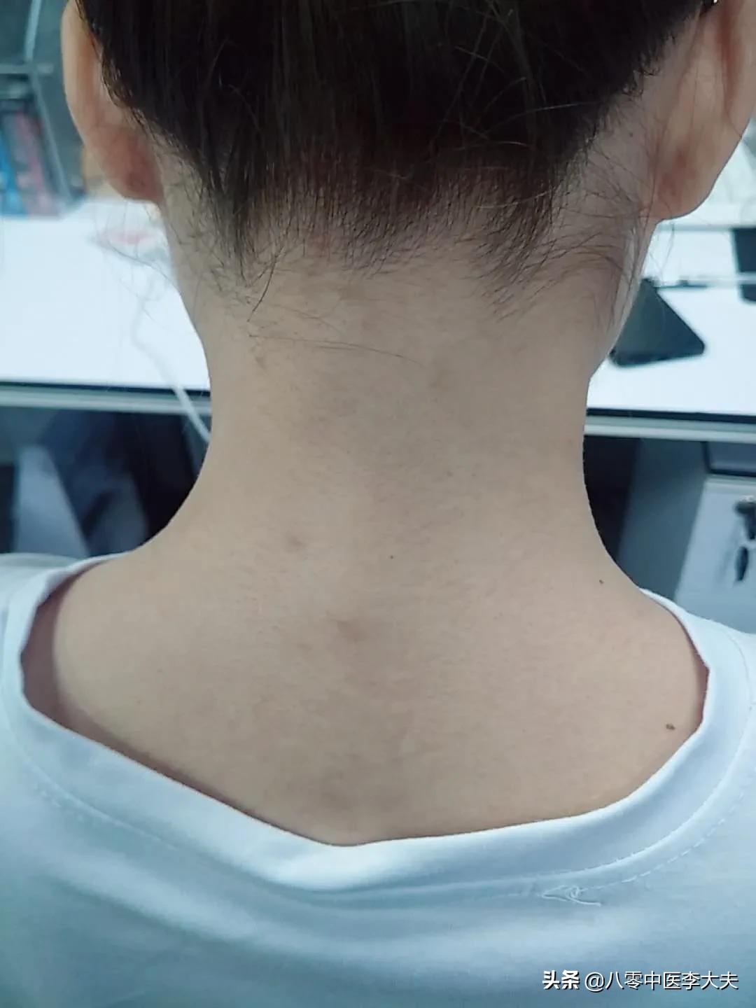 脖子僵硬，疼痛难忍，落枕，颈椎病？葛根汤，舒筋解肌，揉筋止痛