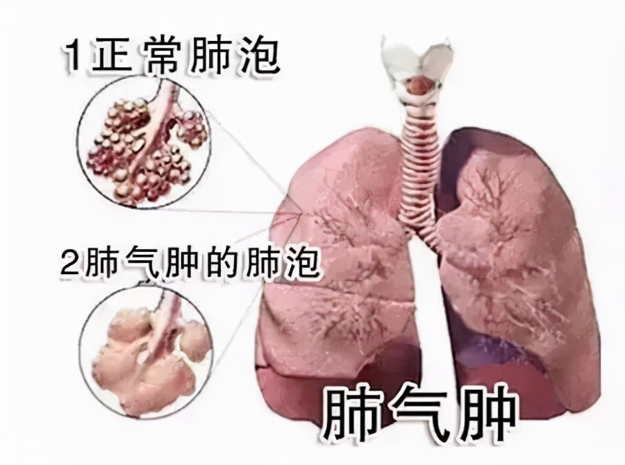 肺气肿？肺泡病理性扩张？出现呼吸困难？怎么延缓病情的发展呢