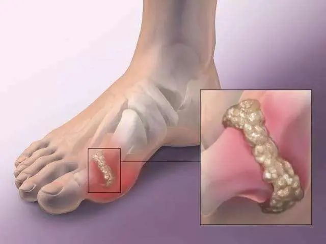 痛风，是不是被吃出来的？别再被折磨了，降尿酸试试这4招