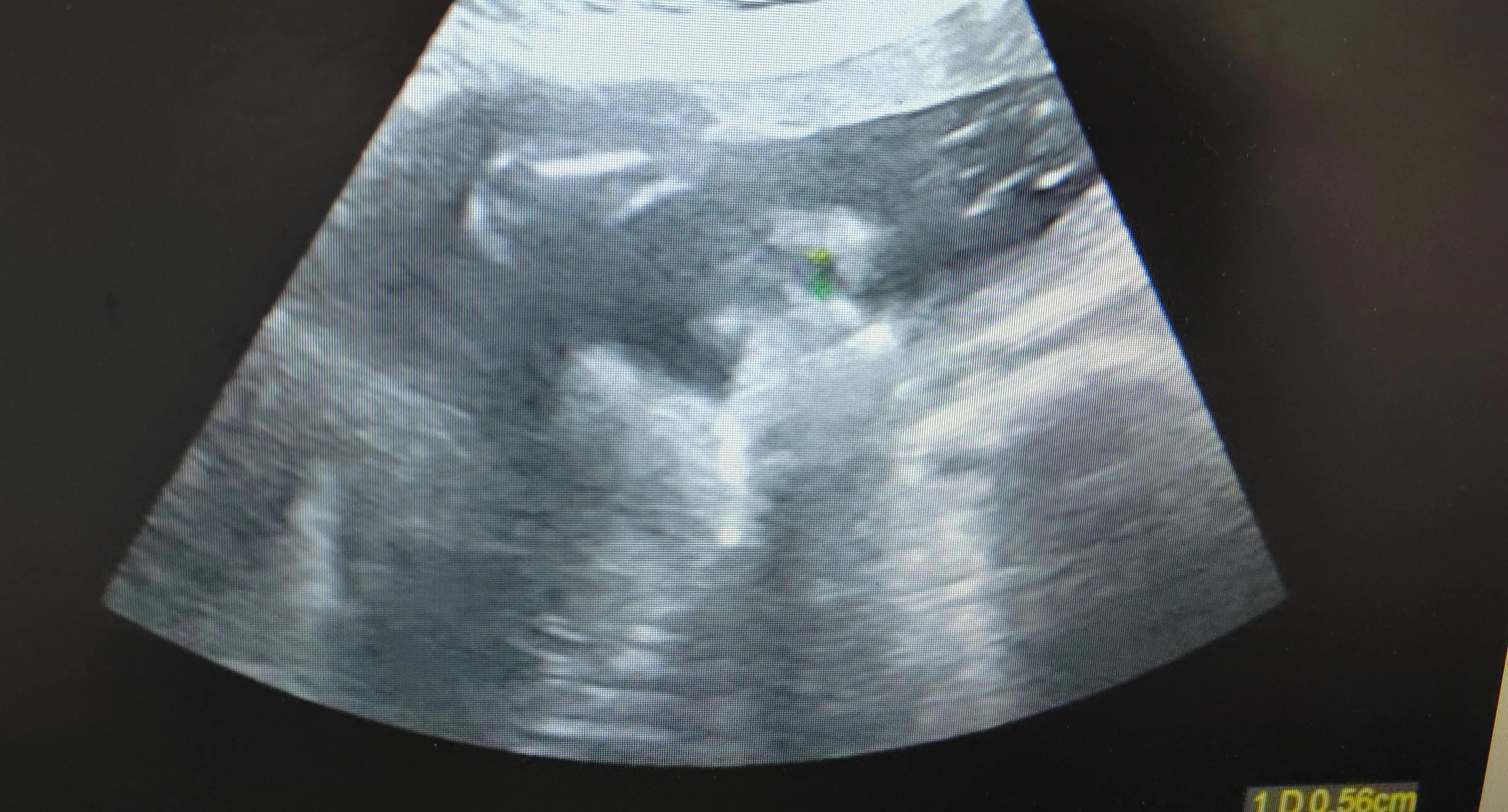 36岁女人怀孕第4胎，6个月只做一次超声，摔倒后听到检查结果哭了