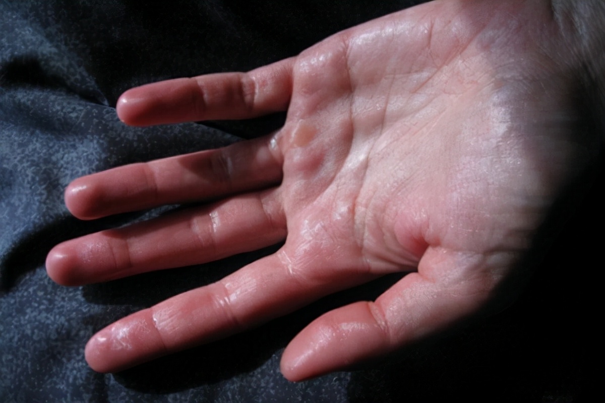 盗汗是什么病的征兆，值得担心吗？如何治疗？