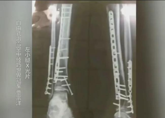 10位让人无比感动的运动员，贾宗洋腿上22根钢钉，武大靖双脚变形
