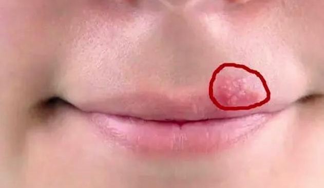 嘴巴周围时不时出现"几个水泡",提示:这不是"上火",会传染