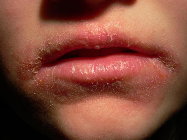 一氧化碳中毒嘴唇图片图片