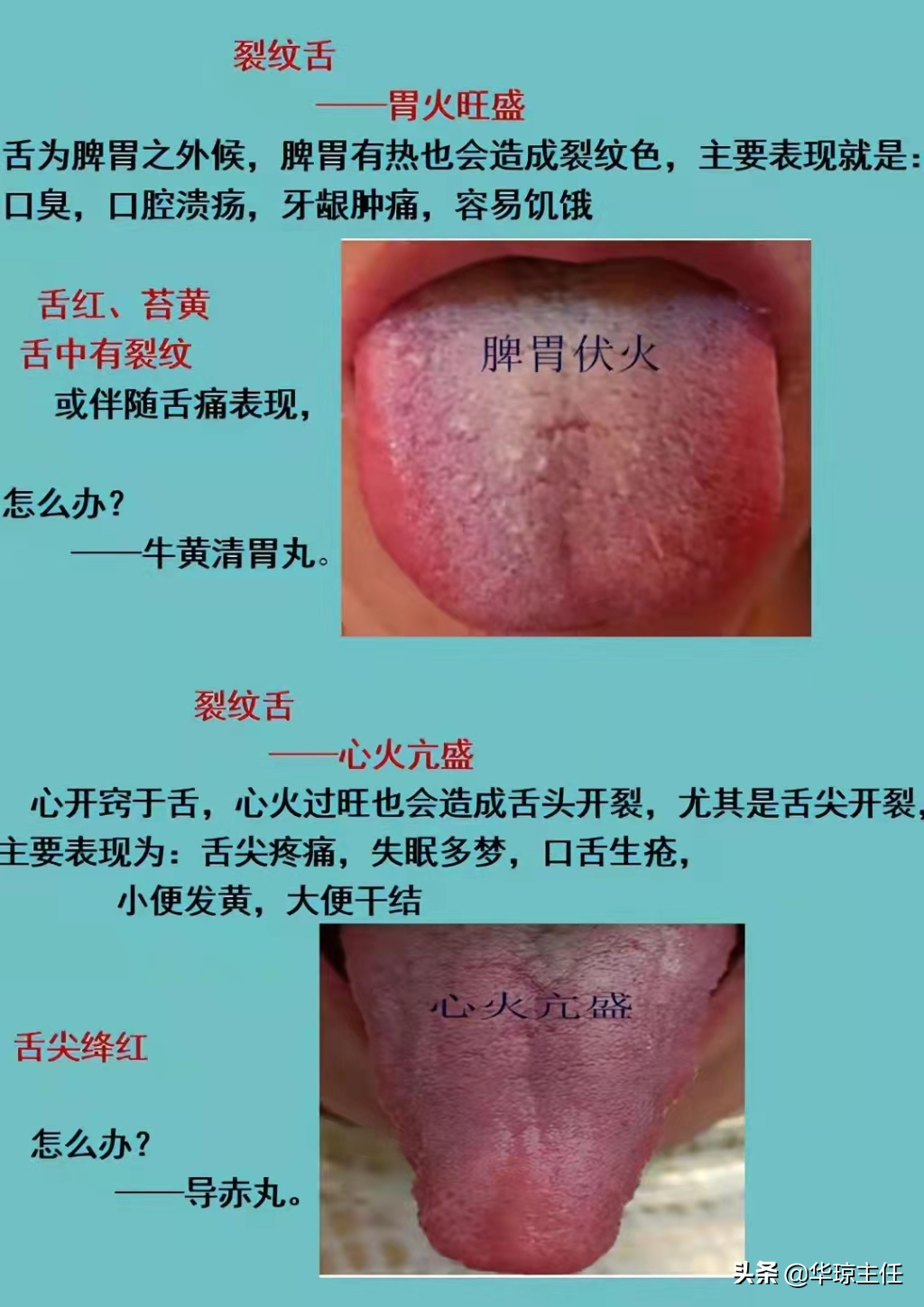 舌有裂纹就是阴虚？四种裂纹舌，十种舌象看看你是属于哪一种？