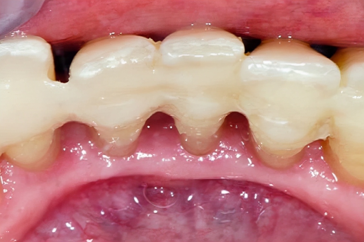 年纪不大,牙齿松动.如何治疗,如何预防?