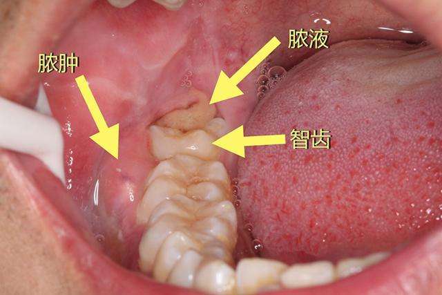 牙龈肿胀怎么解决图片