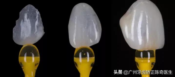 牙黄、牙缝大、牙齿缺损?明星们都在做的牙齿贴面了解一下