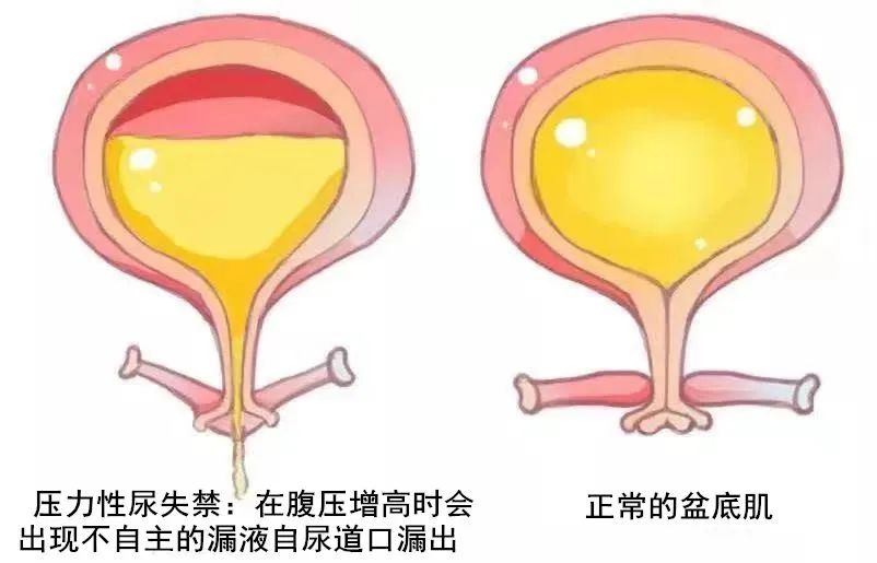 成医附院彭州分院成功实施首例经闭孔无张力尿道中段悬吊术