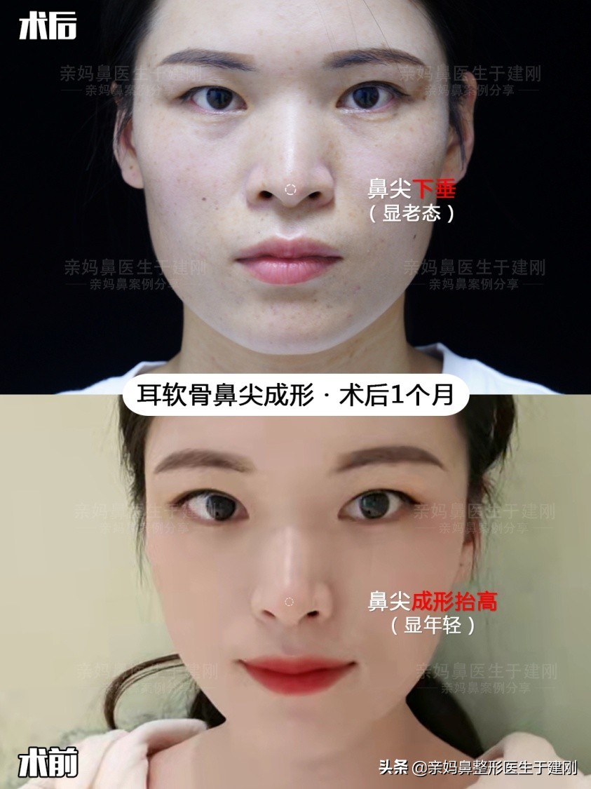 湖北美女鼻尖下垂，鼻子像鹰钩鼻？做完鼻整形后连突嘴也改善了