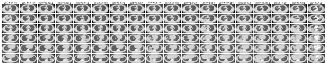 4年反复住院12次、250余天！广西一男子确诊此罕见病，为全国首例成人发病