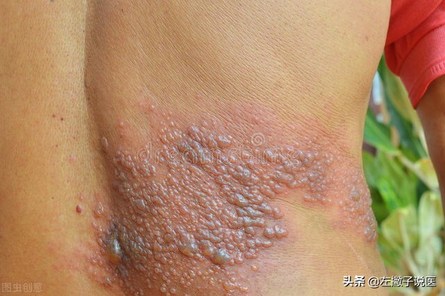 嘴巴疱疹啥症状图片(一旦感染) - 赤虎壹号