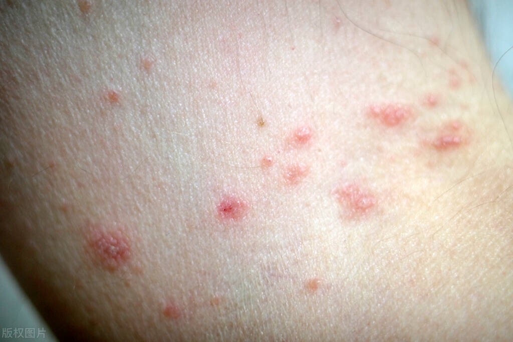 提醒:身体皮肤出现这几个状况,要及时注意,或是艾滋发出的信号