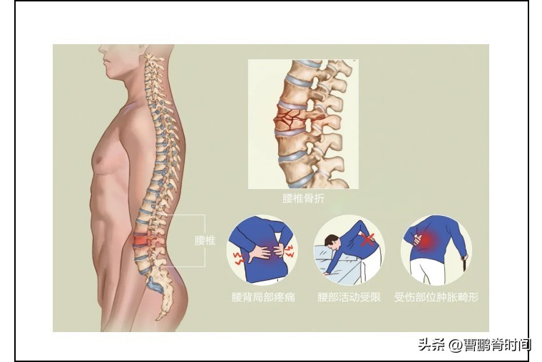 足球比赛腰折是什么意思(跳绳跳到腰椎骨折？原来是藏在脊柱中的“沉默杀手”)