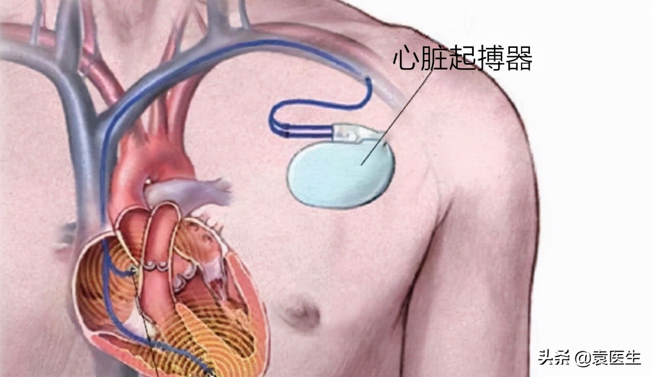 心脏跳得慢怎么办？医生：或要植入“心脏起搏器”