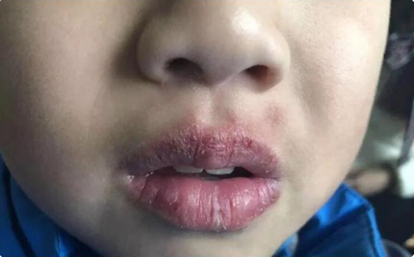冬天嘴唇干裂、起皮还出血，多喝水也没用，这些小妙招学起来