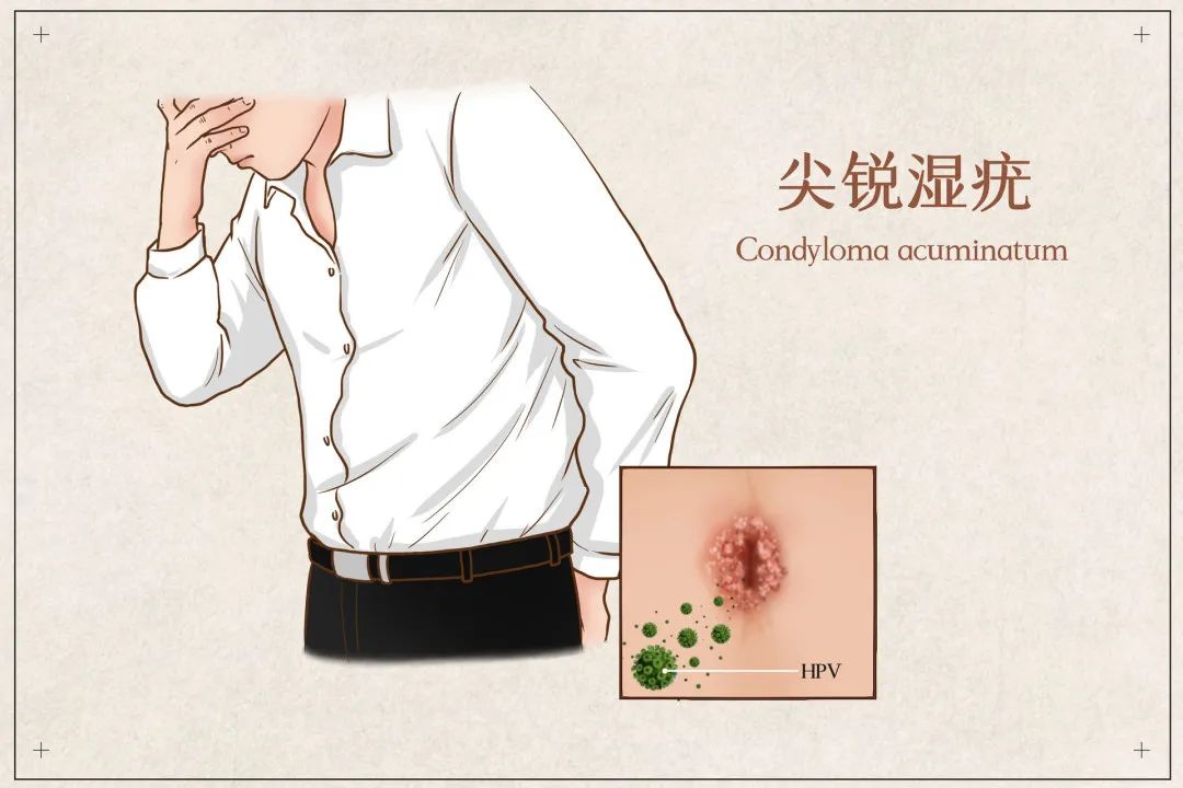 名医科普 | 男性常见性病有哪些?出现这些症状,你可能要警惕了