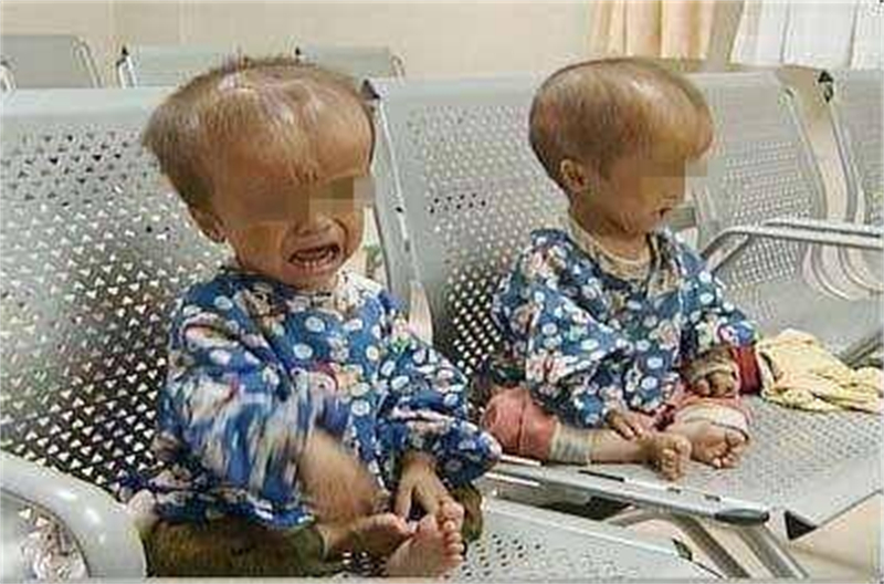 三聚氰胺事件14年，被奶粉毒害的孩子现在怎样了？透析才能活下去