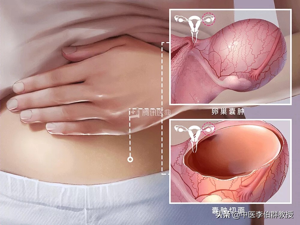 老中医推荐囊肿最佳治疗方法