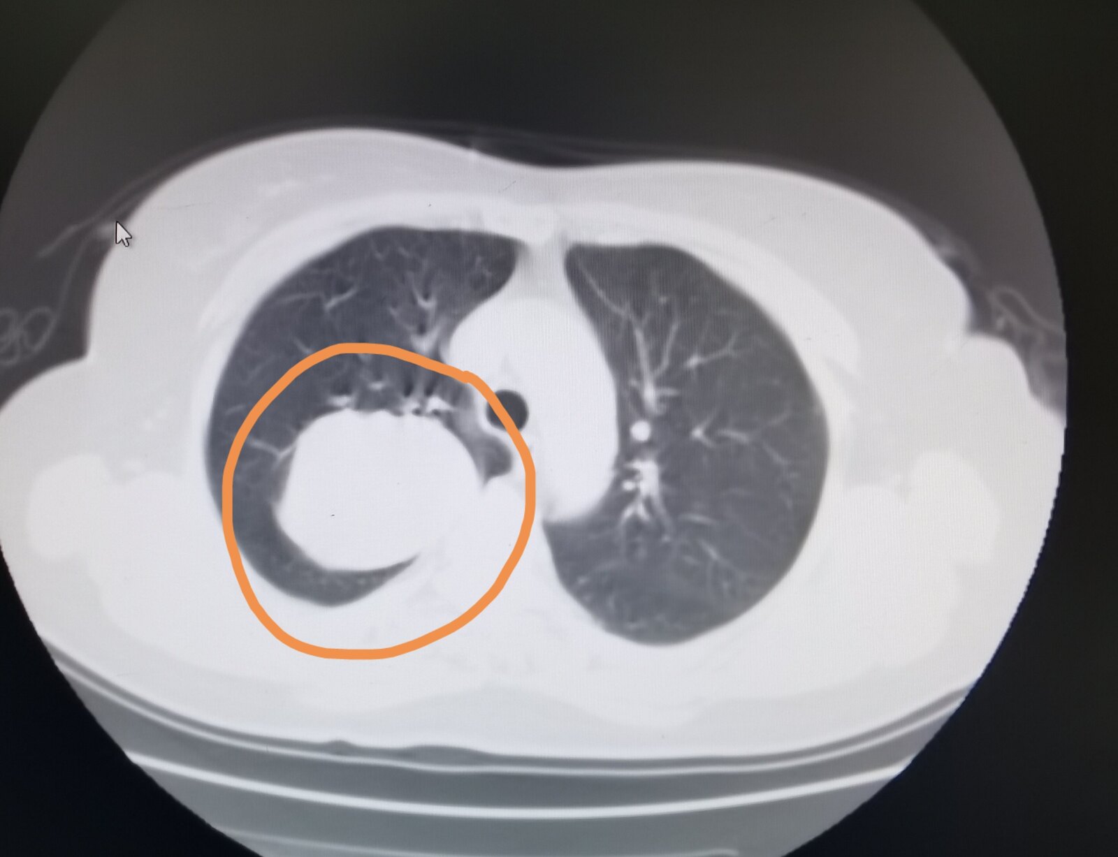 肺上长肿瘤良性的也会长大吗「肺上肿瘤有没有良性的」-友友