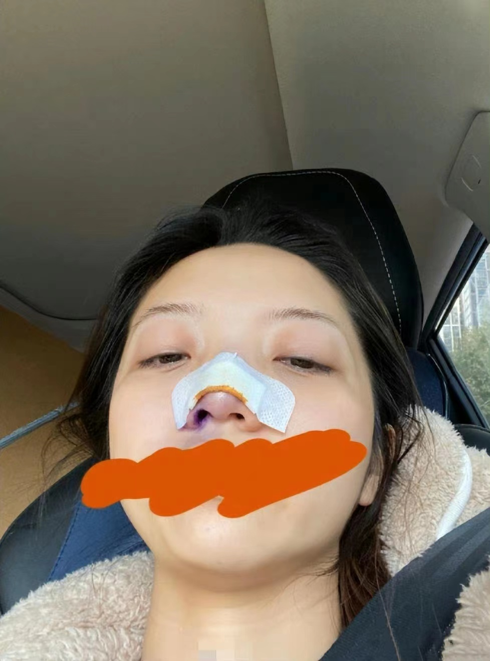 演员张兆艺晒受伤照片,自曝惨遭妈妈家暴,鼻子受伤裹纱眼眶含泪