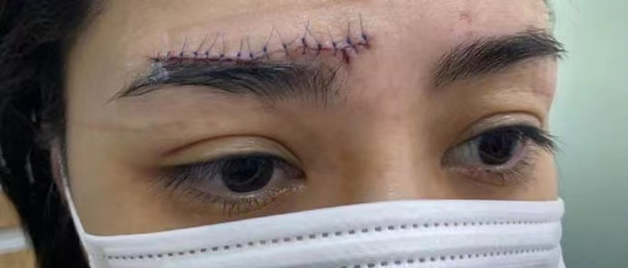 杨幂的眼角，阿娇的脸，明星脸上受伤、毁容，各个让人揪心