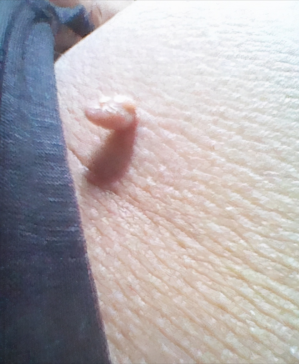 脖子上长了"小肉粒",碍事吗?要不要治疗?医生说明白了