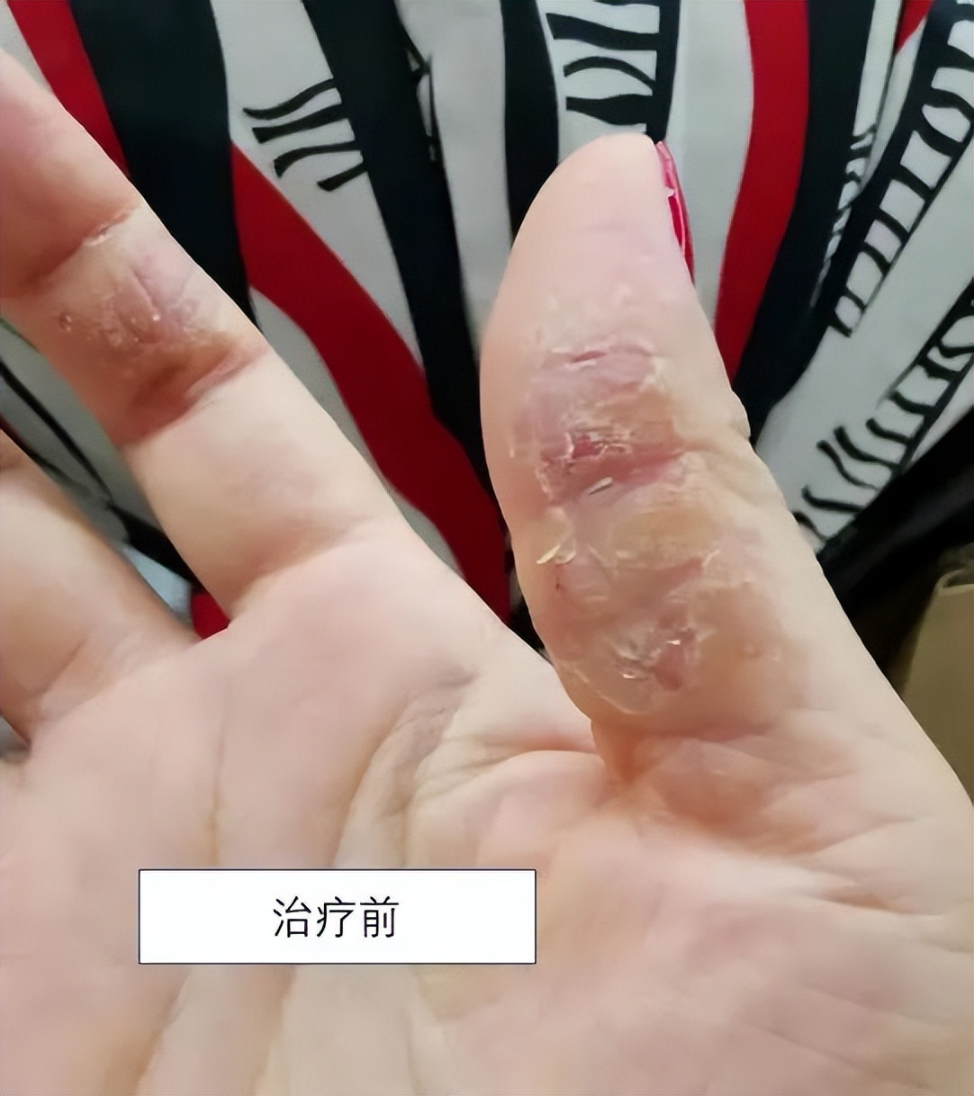 手上濕疹怎么治療（0用藥，只做這件事，就緩解多年頑固手濕疹！）