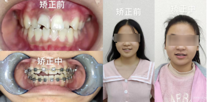 武汉13岁女孩不小心磕掉半边门牙，修复矫正后绽放自信歌喉