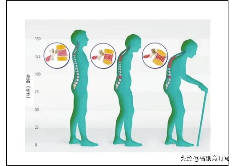 足球比赛腰折是什么意思(跳绳跳到腰椎骨折？原来是藏在脊柱中的“沉默杀手”)