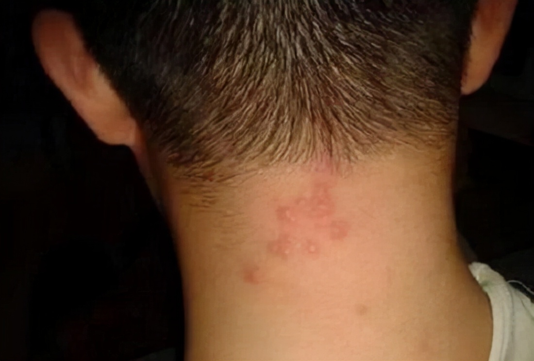 宝宝头上长红疙瘩图片(为啥头皮老是长) - 赤虎壹号