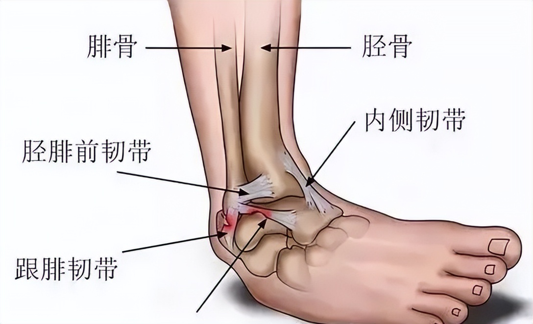 踝关节扭伤后，明明没有骨折为什么还疼痛？