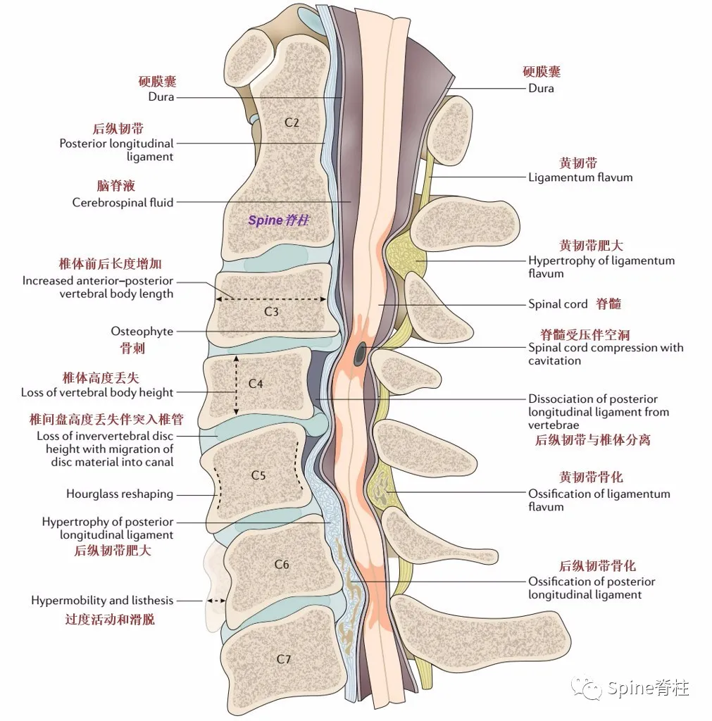 颈椎病：定义、分型、临床表现、治疗和预防